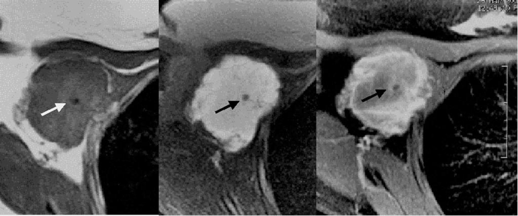 MRI shows a lobulating contoured mass with isosignal intensity on T1-weighted image (left), bright