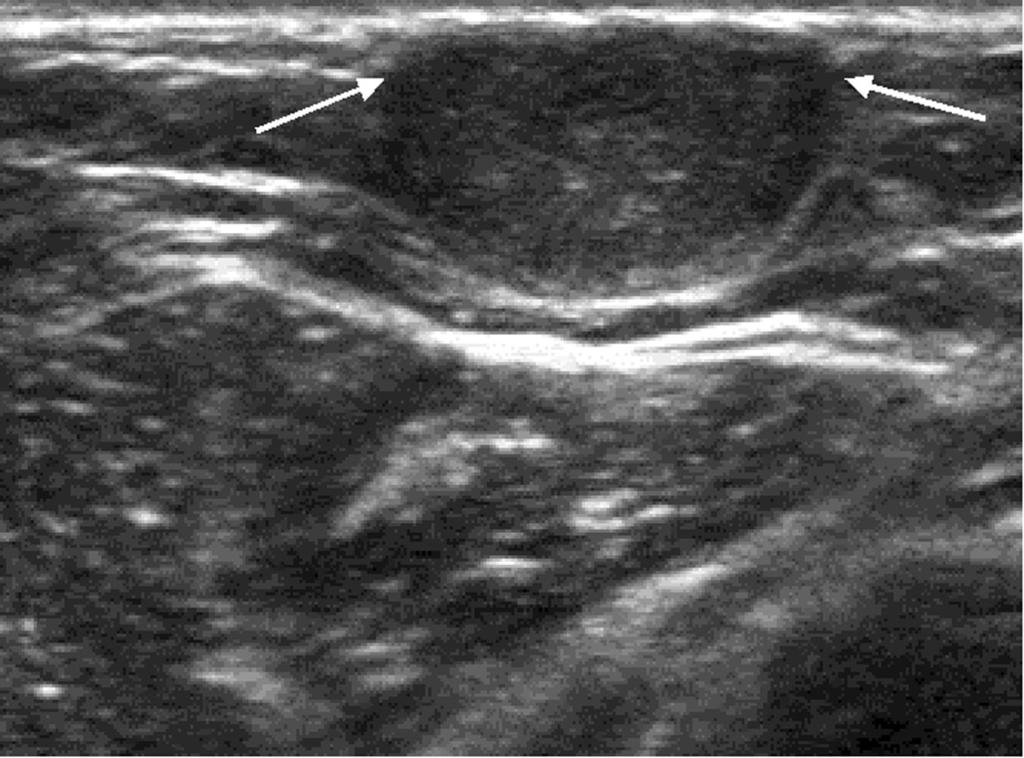 57-year-old-woman with nontender palpable mass in the right axilla.. Mammogram shows radiolucent mass in the right axilla (arrows).
