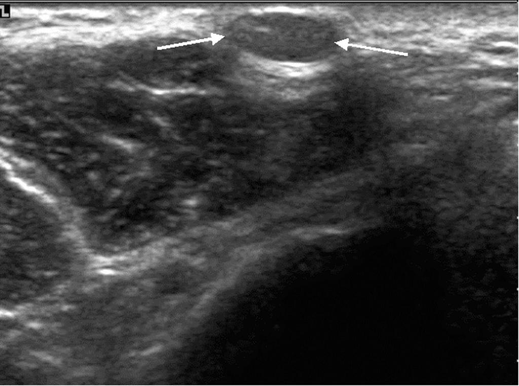 Fig. 13. 35-year-old woman with steatocystoma multiplex.. Right axillary view shows the typical oil cyst (arrow).