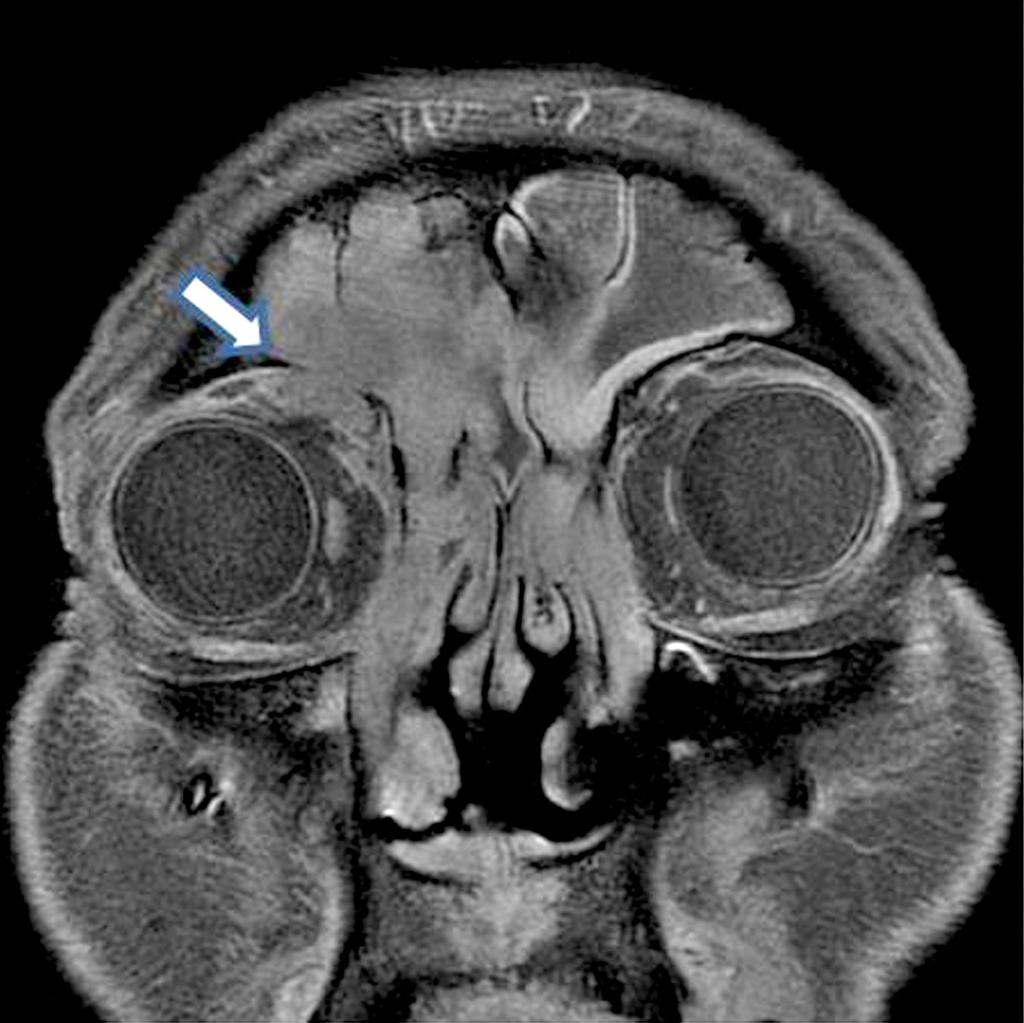 homogenous enhancement of the mass. (C) Slightly homogenous enhanced mass lesion in the frontal sinus shows focal invasion to the right orbital cavity penetrating the superior ortibal wall.