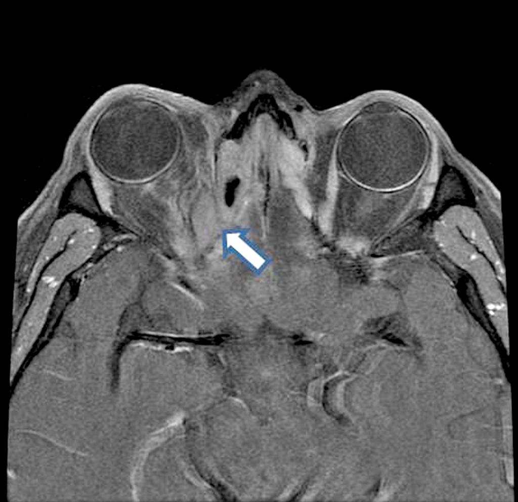 thickening on the right frontal area (black arrow) as well as genetralized mucosal inflammatory thickening in paranasal sinuses.