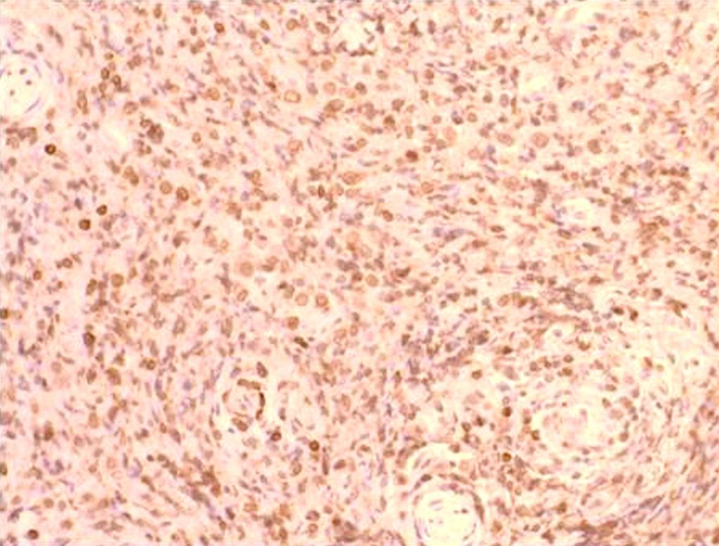 (D) The immunohistochemical stain for Ki 67 reveals highly proliferative rate of lymphocytes (> 90%, Immunohistochemistry Ki 67 200). 의하면 부비동 암종 54명 환자 가운데 안와 쪽으로 침범한 운동 장애, 시력 저하 및 충혈 등을 일으킬 수 있다.