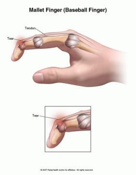 (2) 추지 (Mallet Finger):