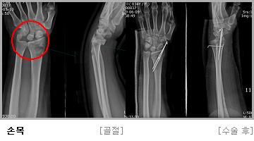 2. 손목 (Wrist) 의골절 대부분수근부를후방굴곡한위치로넘어지면서손바닥에외력이가해져발생