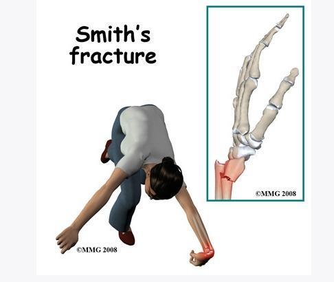 (2) Smith 골절 (= 역 Colles 골절 ) 1정의 : 원위골절편이전방으로전위된요골원위부골절 2발생 : 손등으로짚고넘어지거나수근관절면의배면에직접외력작용시.