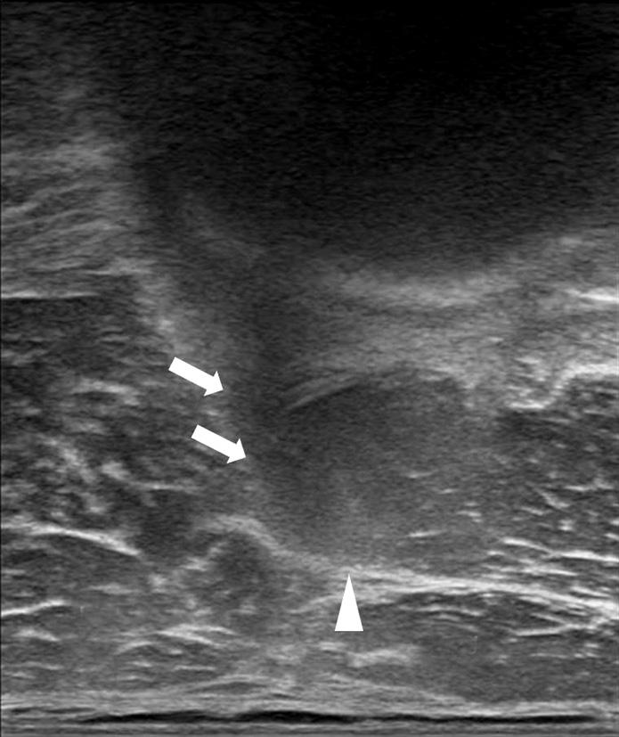478 Kyung-Jae Lee and Jung-Hoon Choi TFL Sa AI Ab FH Am Figure 4. Transverse plane ultrasonography of the anterior-inferior iliac spine level.
