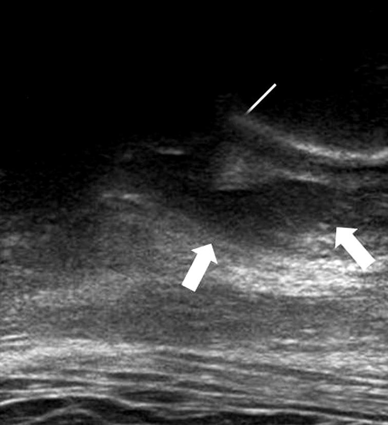 Anterior hip ultrasonography shows calcification in the rectus femoris (block arrow).