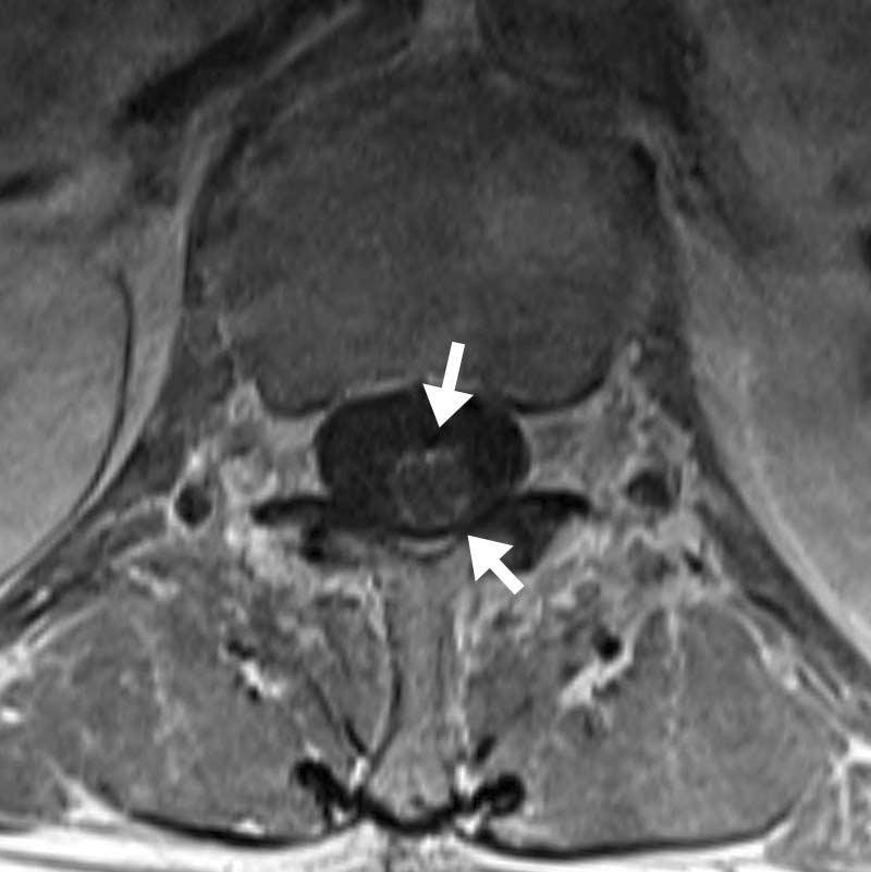 Sagittal (A) and axial (B) contrast enhanced T1-weighted MR images reveals ringlike peripheral enhancement lesions (arrows) in the conus medullaris.