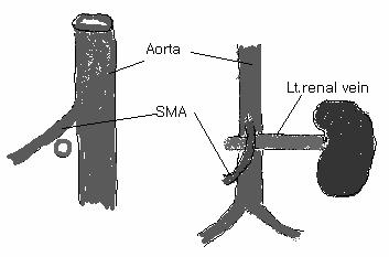 Nutcracker syndrome (renal vein entrapment syndrome) 혈뇨의원인 : 상부요로 (II) Nephrolithiasis, nephrocalcinosis