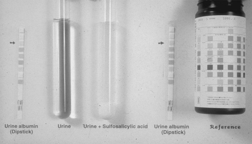 제 8 회분당서울대학교병원내과연수강좌 2012 Measurement of urine protein Semiquantitative tests precipitation tests (5 to 10 mg/dl) adding 5% sulfosalicylic acid or concentrated nitric acid heating the urine and