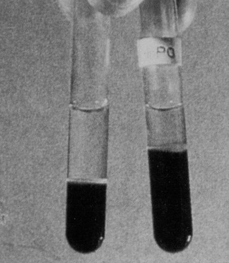 혈뇨의정의 정상 : RBC output <1,000/min 혈뇨 : 1-13% prevalence in adults -