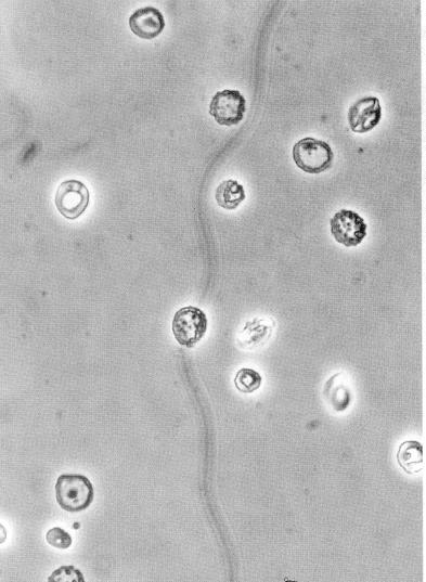 Urine microscopy Erythrocytes