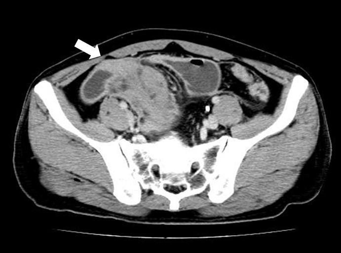 - Kyu-Ho Lee, et al. Ganulocytic sarcoma in nonleukemic patients - Figure 1. The initial abdominal CT shows a well-defined soft tissue mass in the small bowel. Figure 2.