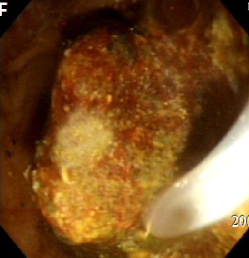 담석의 내시경 치료 유병무 Figure 1. Large balloon endoscopic sphincteroplasty. (A) Multiple extrahepatic bile duct stones were seen.
