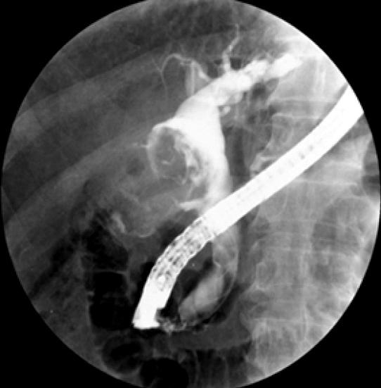 4) 은 재사용 가능한 optical probe, delivery catheter (SpyScope) 의 구성으로 이루어져 있으며 십이지장경의 겸자공에 optic endoscopy를 삽입하여 사용하는 방법으로 한 명의 내시경의사 에 의해 조작이 가능하다는 장점이 있다.