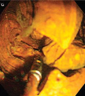 Figure 5. Electrohydraulic lithotripsy (EHL) under direct peroral cholangioscopy (POC) using an ultra-slim upper endoscope for a large common bile duct (CBD) stone.