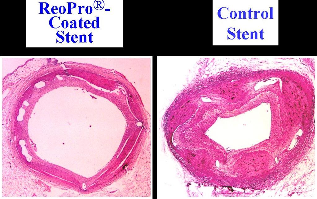 정명호. 새로운 관상동맥 스텐트의 개발 및 가능성 Figure 3. ReoPro-coated stent inhibited neointima formation and platelet thrombus. Figure 4. Alpha-lipoic acid (ALA)-coated stent inhibited neointima formation. 2.