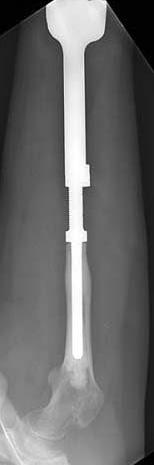 그리고대퇴골원위성장판의경우확 A B C Figure 4. Expandable prosthesis of the distal femur. (A) After resection of the distal femur, custom type expandable prosthesis was placed with cement fixation.