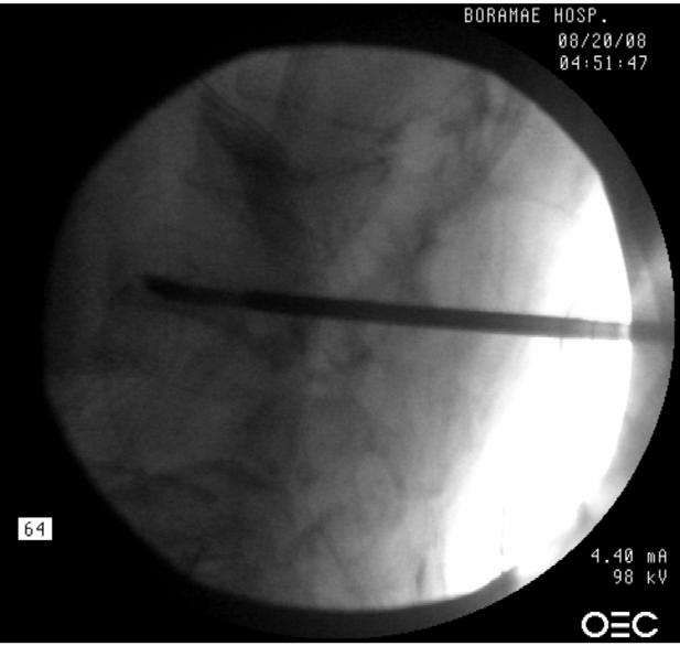 The tips of the J-type biopsy needles are located on the lateral aspect of