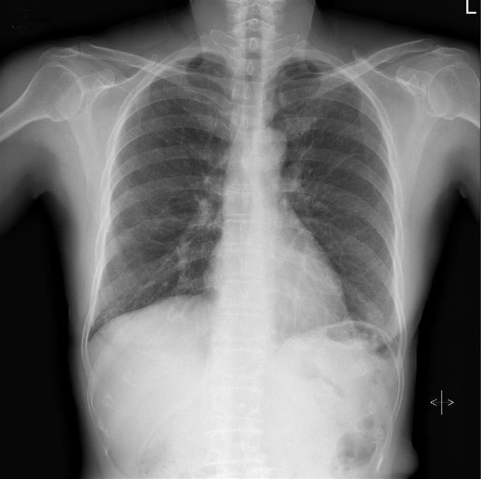 Min Jung Kim, et al. A case of BIP A B C D Figure 1. (A) Initial chest radiography shows multiple nodular and reticulonodular opacities in both lung fields.