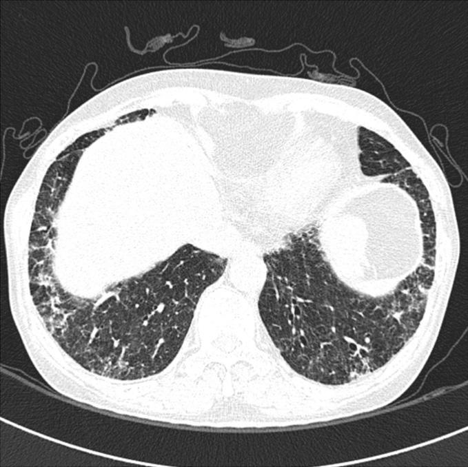 고 stitial pneumonia, NSIP), 기도-중심성 간질성 섬유화(airway- 찰 centered interstitial fibrosis, ACIF), 그리고 특발성 세기관지Bronchiolitis interstitial pneumonitis