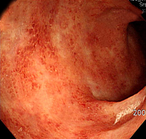 granular mucosal change with mucoid exudates, (C) ectopic inflammation on opening of