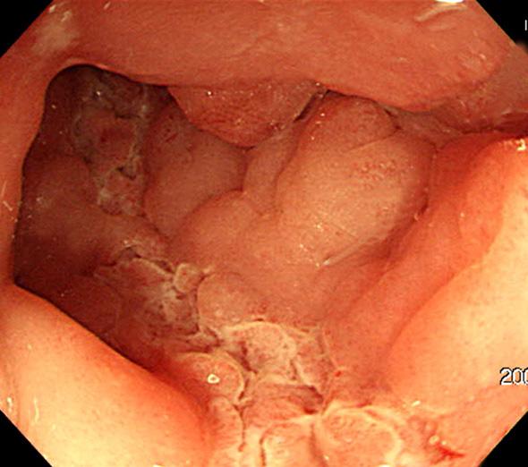 Figure 2. Endoscopic findings of Crohn s disease.