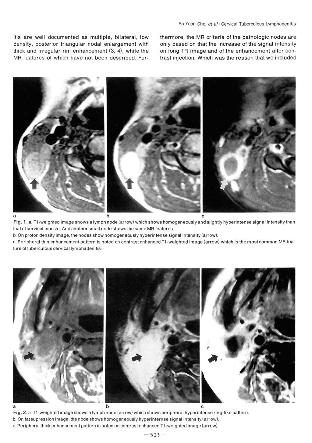 So Yeon Cho, et al: Cervical Tuberculous Lymphadenitis itis are well documented as multiple, bilateral, low density, posterior triangular nodal enlargement with thick and irregular rim enhancement