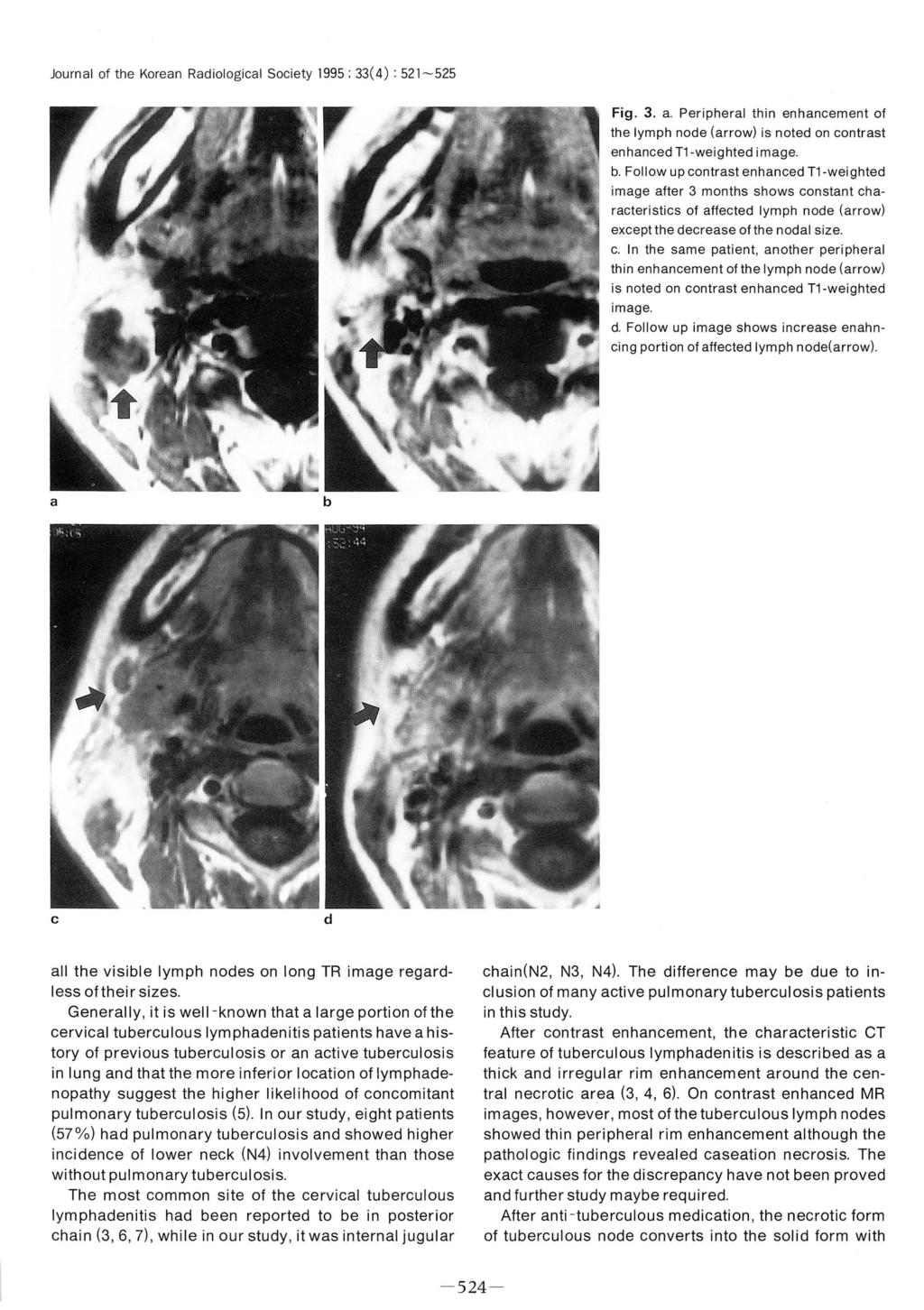 Journal of the Korean Radiological Society 1995 ; 33(4): 521-525 Fig. 3. a. Peripheral thin enhancement 01 the Iymph node (arrow) is noted on contrast enhanced T1-weighted i mage b.