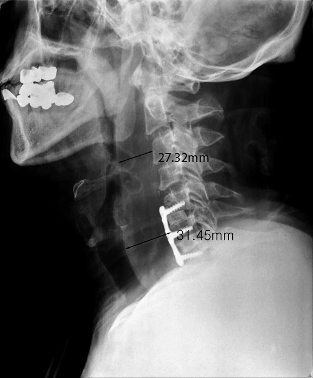 환자수술후 1 일째아침 7 시에시행한경추부측면방사선소견상제 3 경추 체의전방과인두사이의거리는 4.