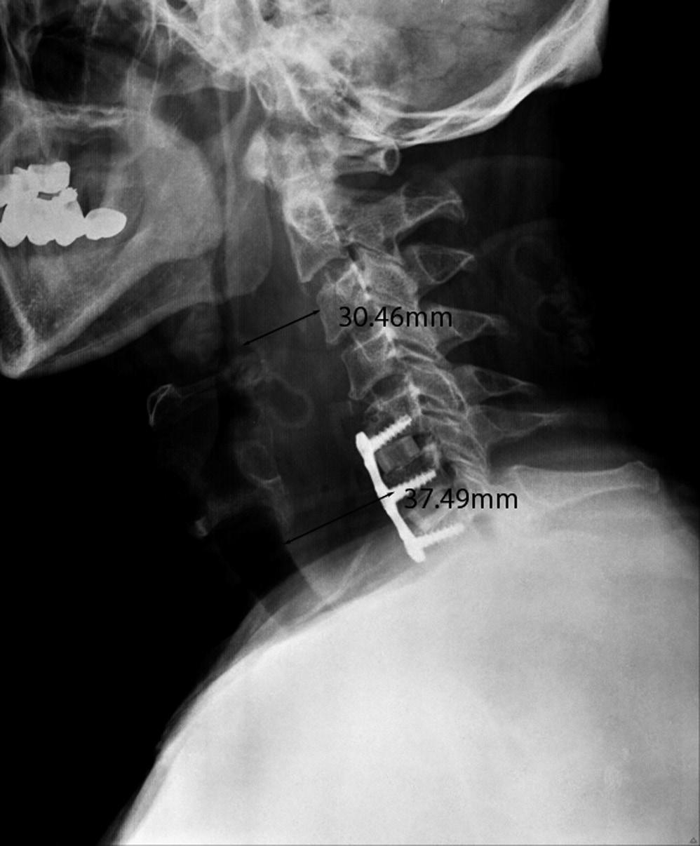 2. postoperative serial x-rays (post op 1day 07:00)