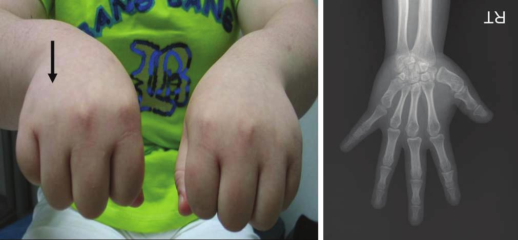 - 대한내과학회지 : 제 74 권부록 1 호 2008 - A B Figure 2. Both hands and hand X-ray findings of the older sister. (A) Hands of the older sister.