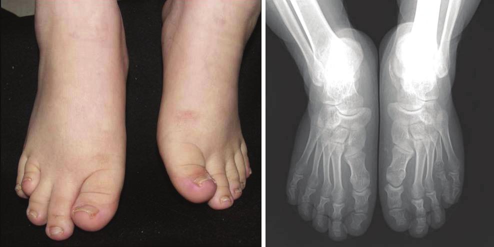 Radiographs showed shortened 4th and 5th metacarpal bones in the right hand. A B Figure 3. Feet and both foot X-rays of the older sister. (A) Feet of the older sister.