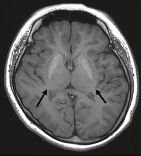- 이인석외 6 인 : 자매에서발생한가성부갑상선기능저하증 2 예 - Figure 4. Brain MRI of the older sister. Typical calcification of the basal ganglia was observed on T1-weighted imaging (arrow). 흡수분당 20회, 맥박수분당 70회, 체온은 36.