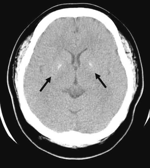 - 대한내과학회지 : 제 74 권부록 1 호 2008 - Figure 6. Brain CT scan in the younger sister. Typical calcification of the basal ganglia was observed on brain CT (arrow).