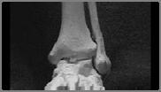 injury Peroneal subluxation Ant.