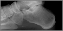 X-ray: Anterior spur