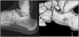 Anterior process fracture of