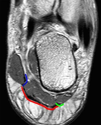 3 bands: central, medial, lateral m/c affected in central band Thickness :