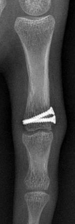 dislocation. () Preoperative radiographs.