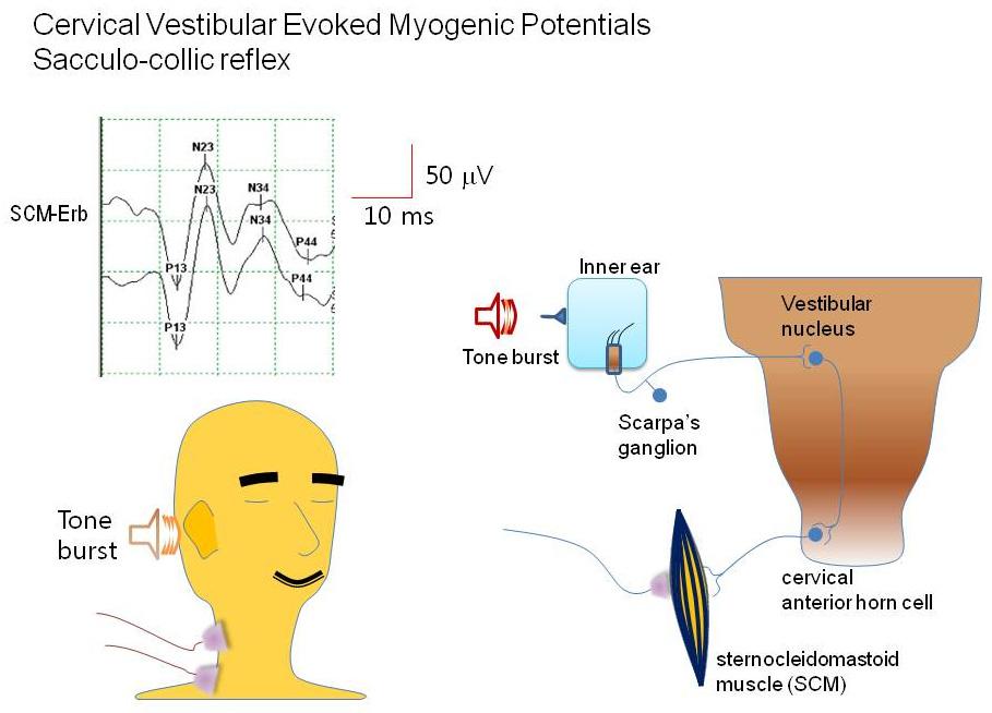 감각신경계의신경생리와임상적이용 Figure 7. Generation of potentials along the auditory pathways. The data show wave I, II, III, IV, and V at Cz electrode, based on ipsilateral or contralateral ears. Figure 8.