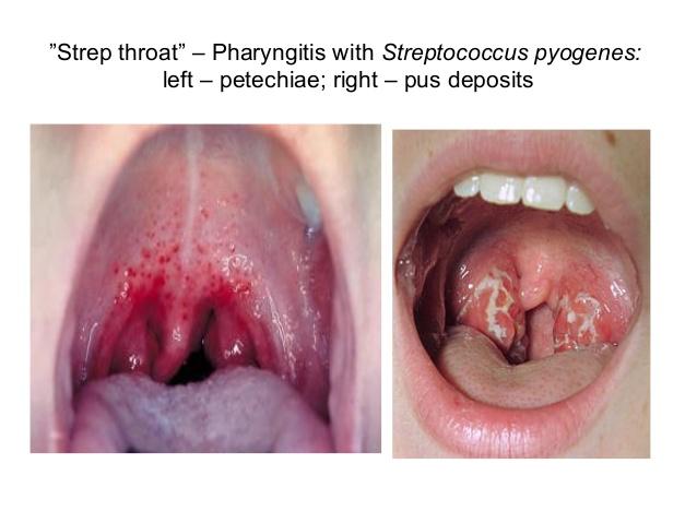 인두염 (Pharyngitis) - 병원균 노출 후 2~4일에 인후통, 열, 권태감,