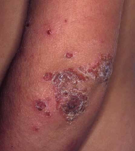 고름피부증 (Pyoderma), 고름딱지증 (Impetigo) - 주로노출된부위 ( 얼굴, 팔, 다리 ) 에발생하는국소적화농성피부염