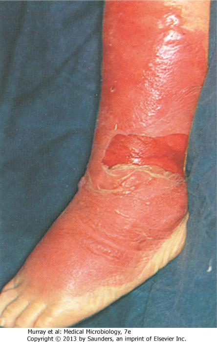 고름물집이되어터지고그위에딱지가생긴다 - 전신적감염증후는없음 단독 (Erysipelas) - 피부의급성감염 ( 피부에보라색의융기된병소