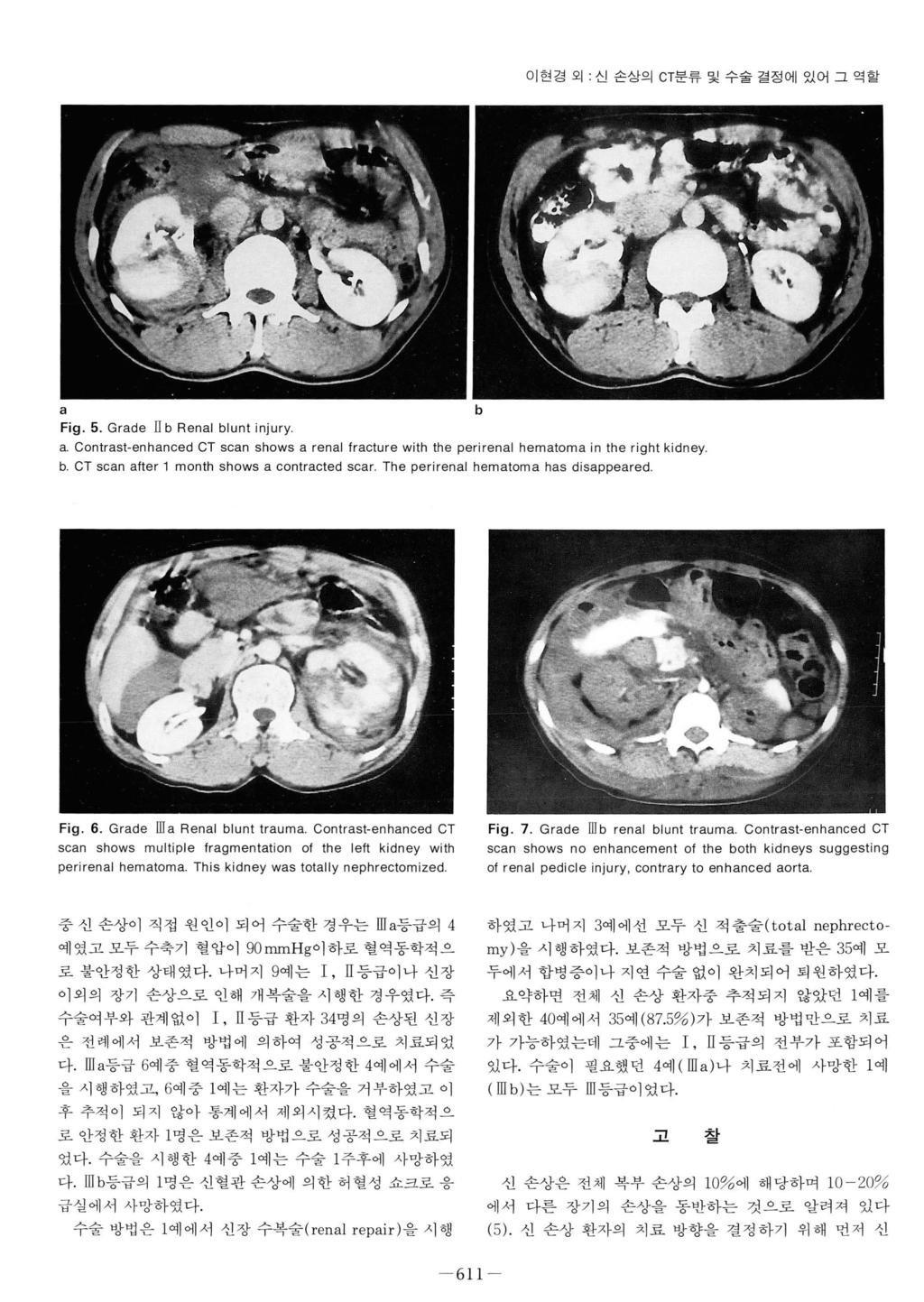 이현경외 : 신손상으 I CT분류및수술결정에있어그역할 a Fig. 5. Grade II b Renal blunt injury a. Contrast-enhanced CT scan shows a renal Iracture with the perirenal hematoma in the right kidney b.