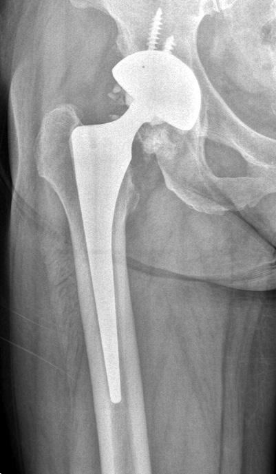 Anteroposterior radiographs showing the right hip of a 61-year-old female who underwent a total hip arthroplasty.