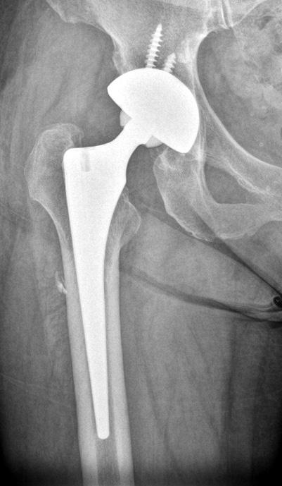 (C) Radiograph taken 48 months after total hip arthroplasty.