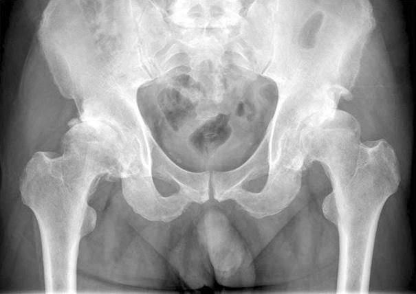 130 이중명 전재범 Figure 3. (A) Preoperative anteriorposterior radiograph of a 55-year-old male with osteoarthritis of both hip joints.