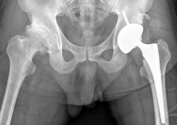 (D) At postoperative six years, anteriorposterior radiograph shows good bony fixation of the femoral stem. Bone ongrowth was noted (arrows). 그크기는 1-2 cm 정도로스템의견부에서주로관찰되었다.
