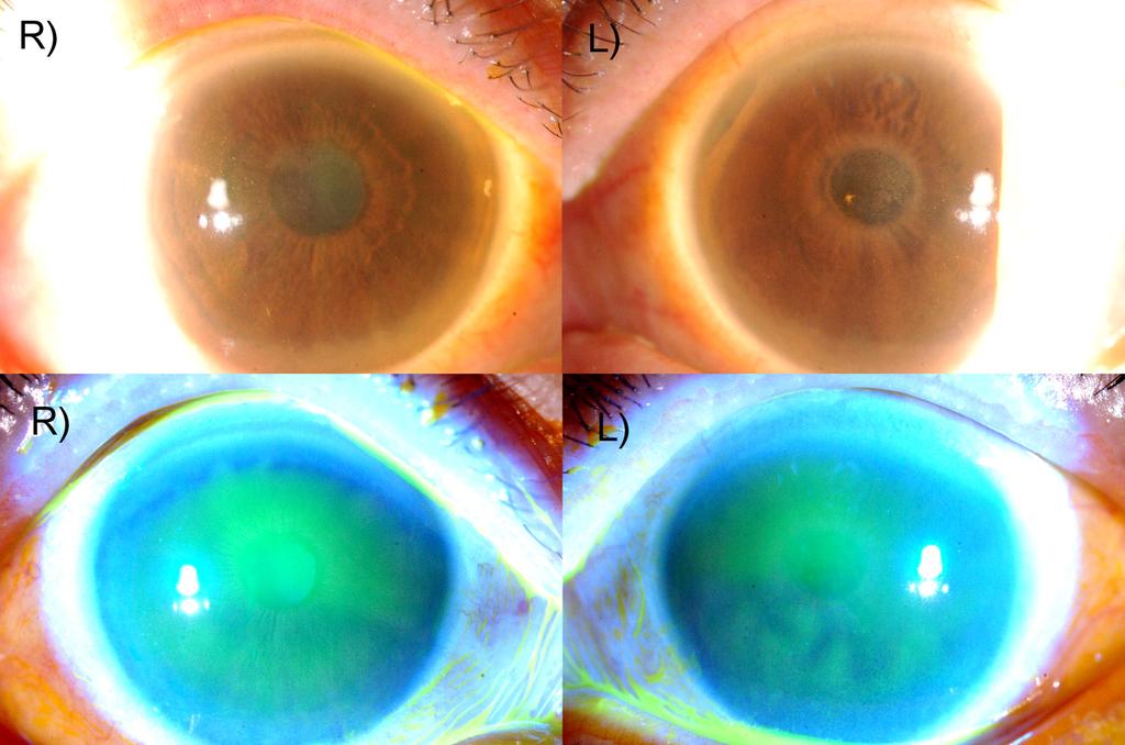 - 이은정외 : 히알우론산나트륨점안액독성각막염 - A B C Figure 2. Slit-lamp photography of the patient one month after discontinuation of the eyedrops under white light (A, B) and cobalt-blue light (C, D).